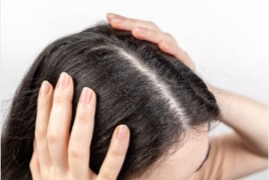 dandruff